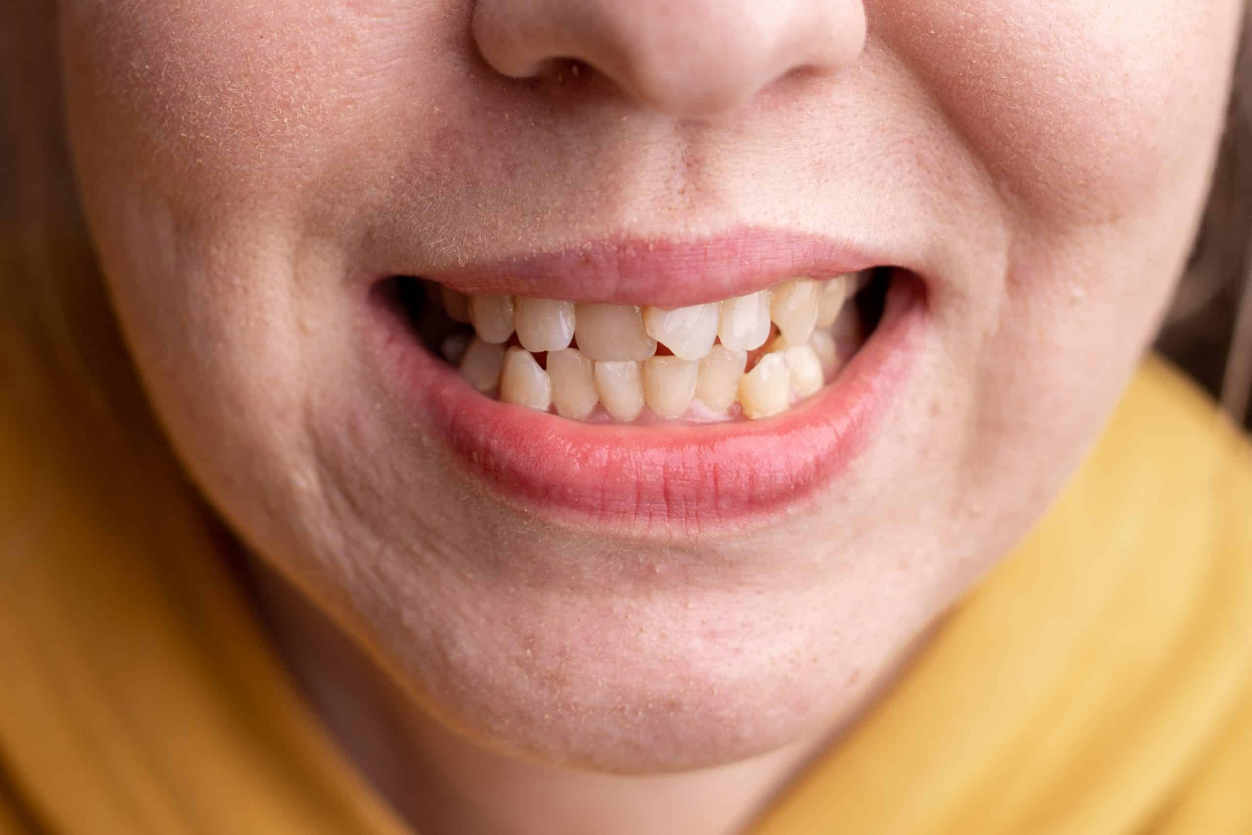 crowding of the front teeth